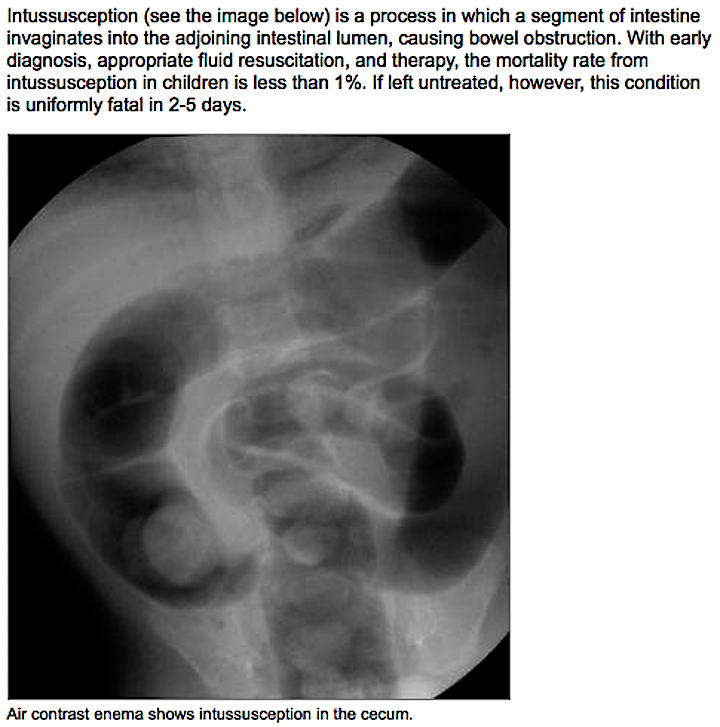 Medxclusive Learning Intussusception Is A Process In Which A