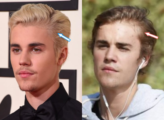 Before And After Justin Bieber Plastic Surgery