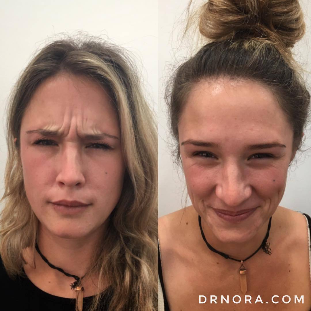 It takes more muscles to frown than it does to smile, so why frown at all? That’s exactly what this lovely patient wanted with her anti-wrinkle treatment! Her frown has vanished and she instantly looks happier and fresh faced.
Anti-wrinkle treatment...
