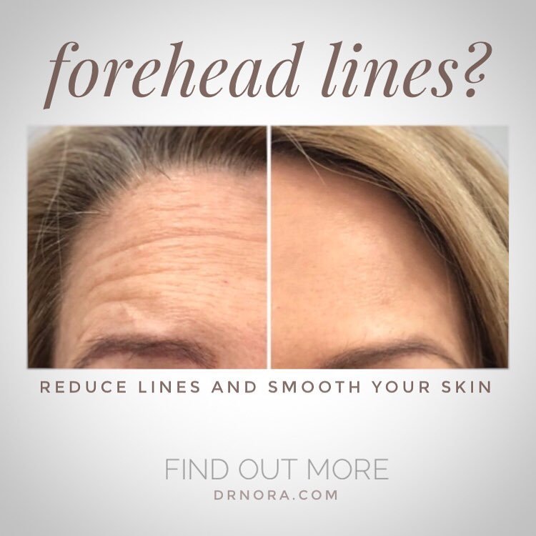 ‘Are you using a new moisturiser?’ Is a question a lot of my patients get asked after their anti-wrinkle treatment and you can see why.This beauty had her upper face treated which not only reduced appearance of fine lines but also improved her skin...
