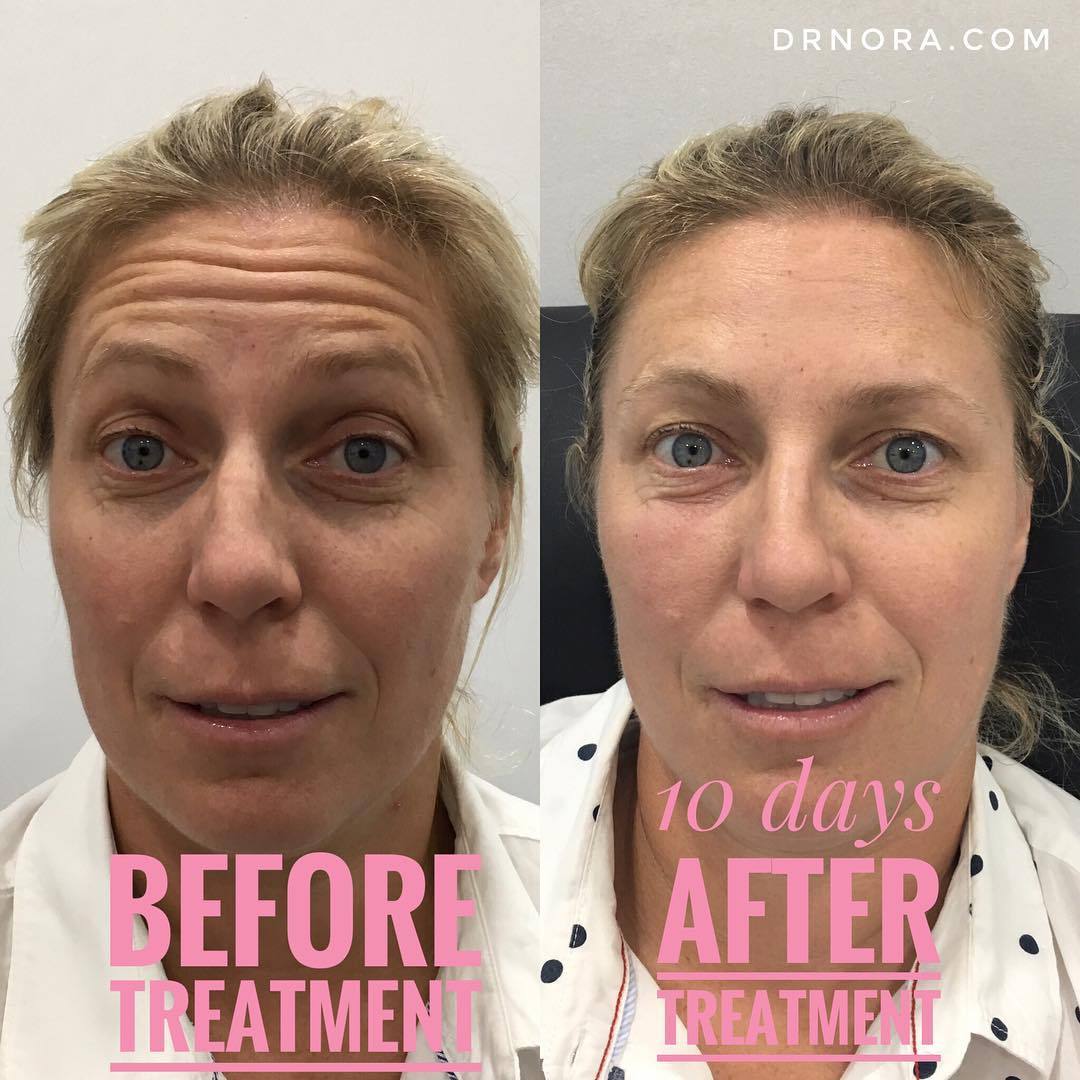 Forehead lines no more! 😮Look at this fantastic result just 10 days after anti-wrinkle treatment! 💉
Anti-wrinkle treatment is a quick and easy way to reduce facial lines giving a fresh and youthful appearance. This lovely lady had a fantastic outcome...