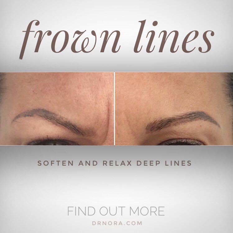 Don’t frown it’s almost the weekend! 😁Anti-wrinkle therapy is a quick and easy way to reduce the appearance of strong and deep frown lines.
With treatment expected to last from 3-5 is it time you turned that frown upside down?
If you have any...