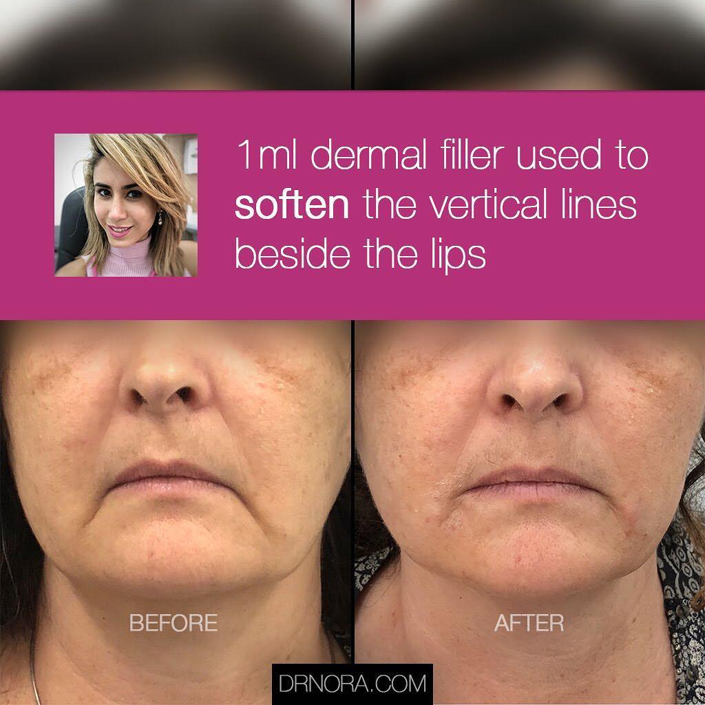 Look sad but don’t feel it? 🙃It’s easy to turn that smile from upside down with some dermal filler carefully placed along the vertical lines beside the lips to create an upward smile.
Which is exactly what this lovely patient had done. As you can see...