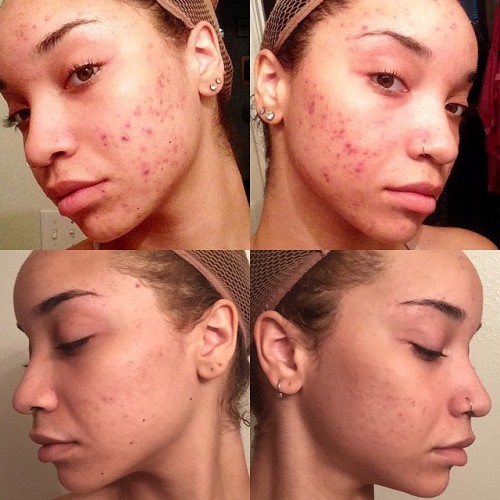 severe acne dating