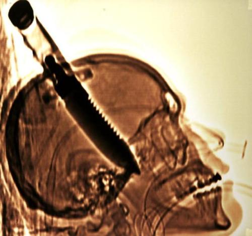 luciferlaughs:The 1998 skull X-ray of Michael Hill, who was...