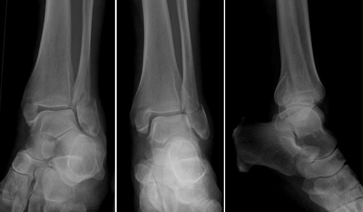 trimalleolar-fracture-learned