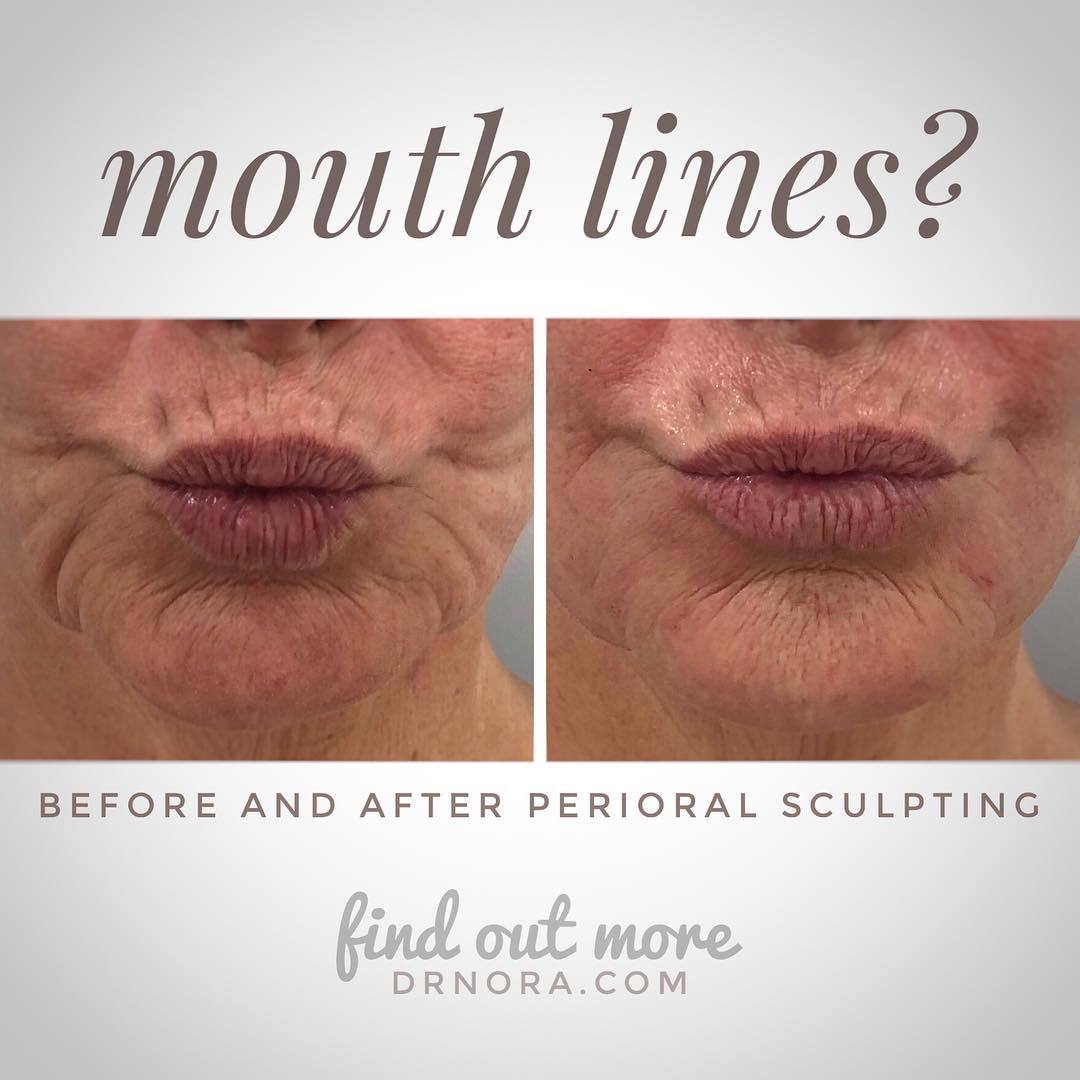 A lot can be achieved with dermal filler, a cannula and an artistic eye! This lovely patient wanted to start her cosmetic journey by addressing her lower face lines. In the treatment I used a cannula (blunt plastic thin tube) to strategically place...