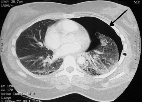 Current trends of clinico-radiological findings, management and outcomes of  chest trauma patients in a tertiary health care hosp