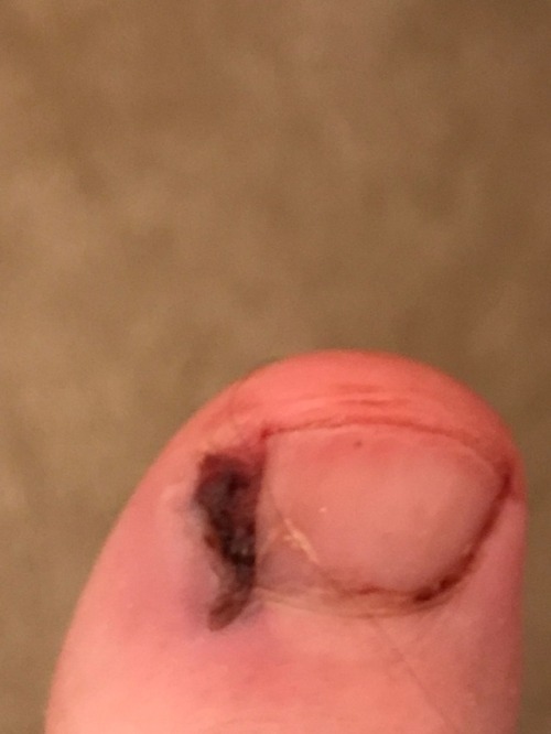 My newest pain…ingrown toenail surgery...