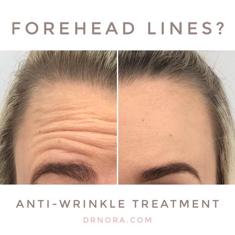 How smooth is her skin?! This lovely patient had her first ever anti-wrinkle treatment to her forehead and frown and she absolutely loved the results and you can see why! Her dynamic forehead lines have gone and her skin looks healthy and glowing....