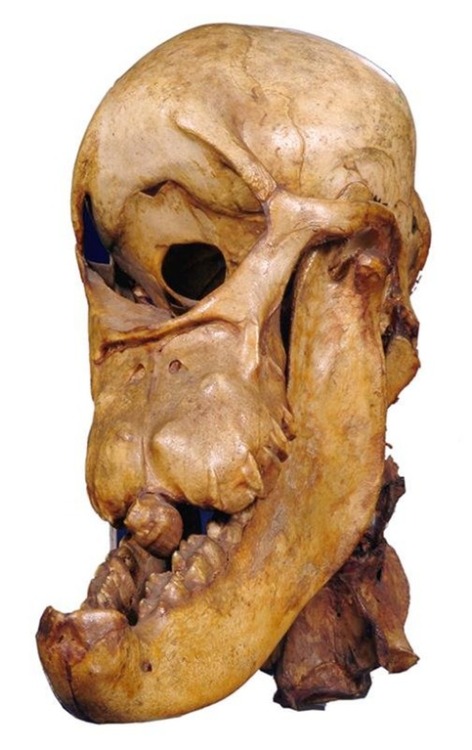 oceantacos:
“ sixpenceee:
“  Skull of a horse with cyclopia from 1841   Cyclopia: A congenital abnormality (birth defect) in which there is only one eye. That eye is centrally placed in the area normally occupied by the root of the nose. There is a...