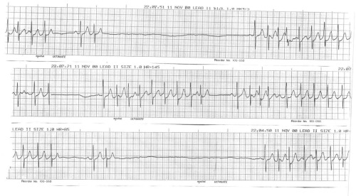 icd 10 for sick sinus syndrome