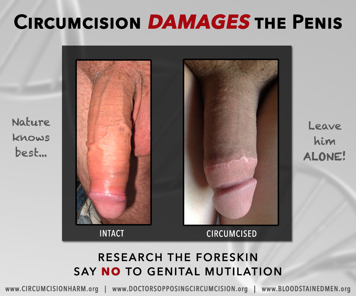 Circumcised versus uncircumcised diagram