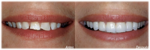 carillas dentales en badalona
