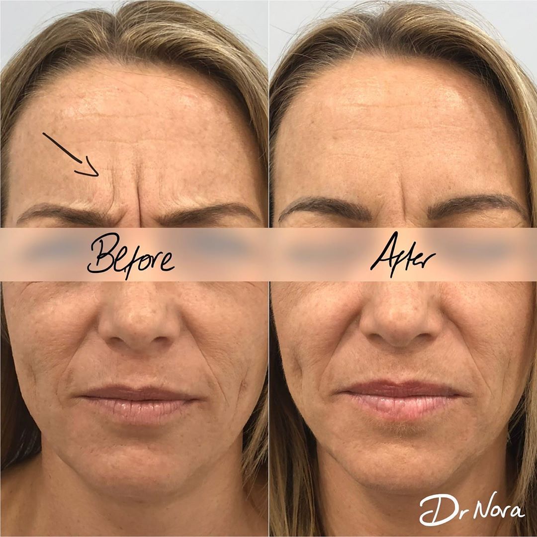 Anti-wrinkle treatment of the frown 😲Anti-wrinkle therapy is a quick and easy way to reduce the appearance of strong and deep lines. Treatment time is 15 minutes, optimal results are seen at 2 weeks and lasts up to 3-5 months.
If you have any...