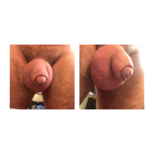 FORESKINBULGE