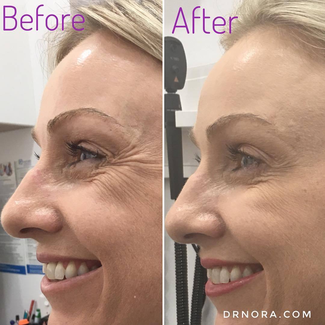 Love laughing but don’t love the laughter lines? Anti-wrinkle treatment is a quick and easy way to reduce lines around the eyes giving a fresh and youthful appearance. This lovely lady had a fantastic outcome and was very pleased with her...