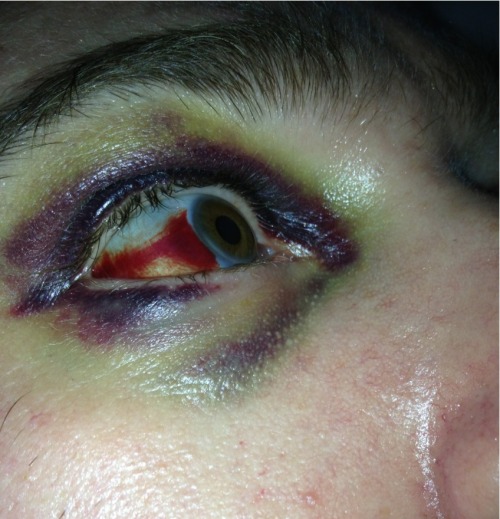 The black eye a few days later