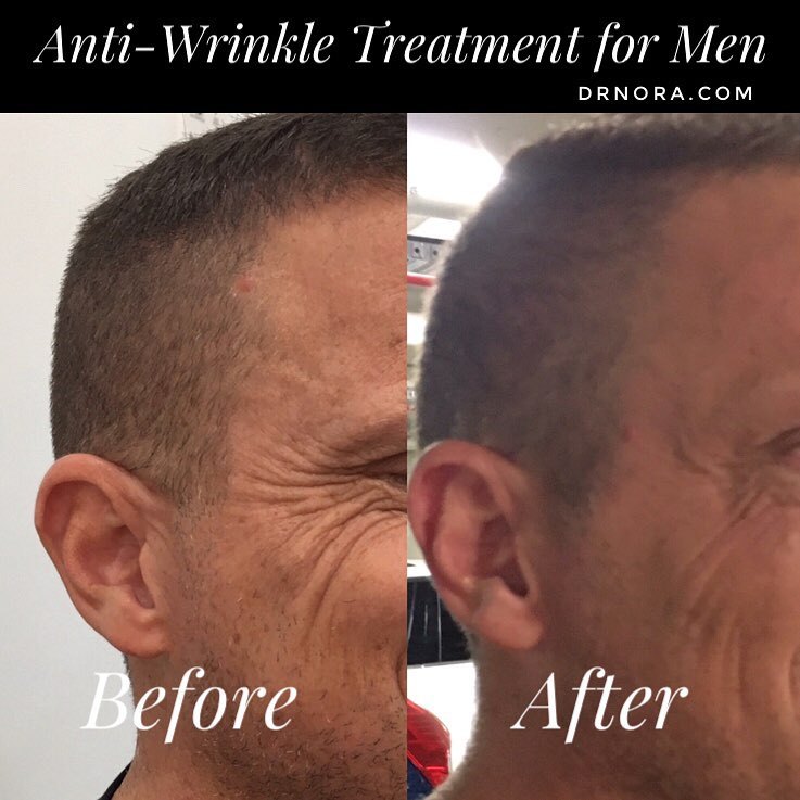 Anti-wrinkle treatment for men! With results expected to last up to 3-5 months, many more men are signing up of anti-wrinkle treatment to get a fresher, youthful look.
Is it time you got onto the ‘Brotox’ movement? ๐
Book in today for a consultation...