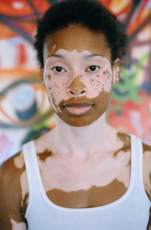 Vitiligo is a condition in which people lose... - The Black Woman's Bible