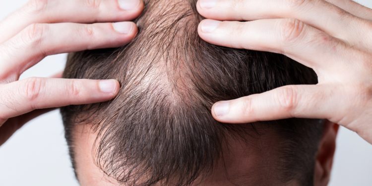 Danielalanio What Is The Best Treatment For Baldness