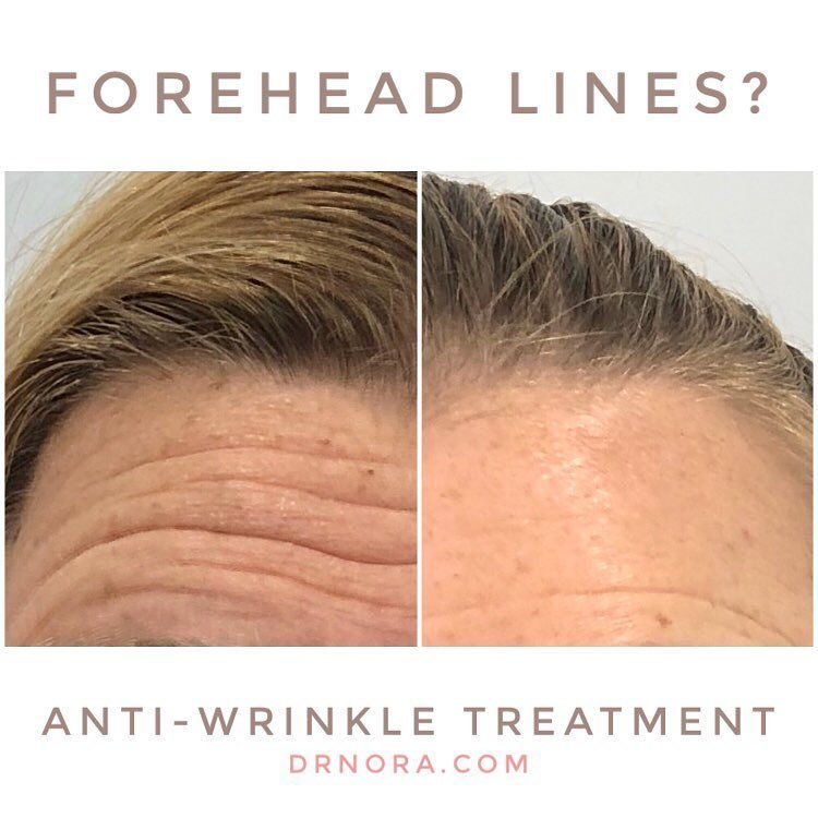 Want smooth, dewy skin?Yes please! This gorgeous lady loves the effect anti-wrinkle treatment has on her forehead. Her skin looks more relaxed, smoother and youthful, go girl!
Anti-wrinkle therapy is a quick and easy way to minimise signs of ageing,...