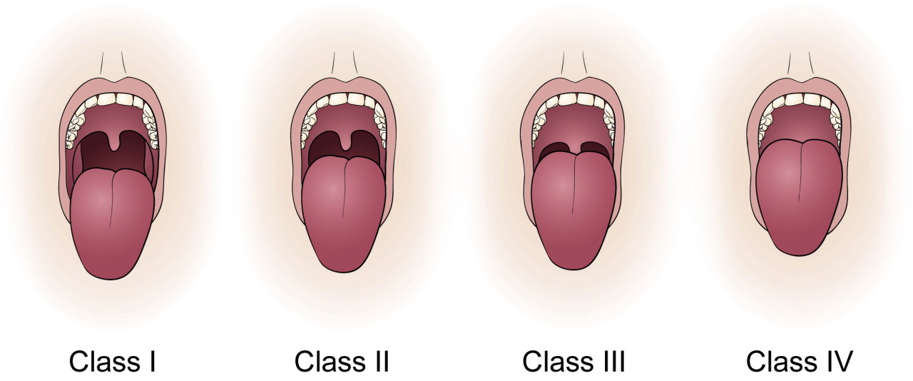 CluelessMedic — Mallampati Assessment used in the anaesthetists...