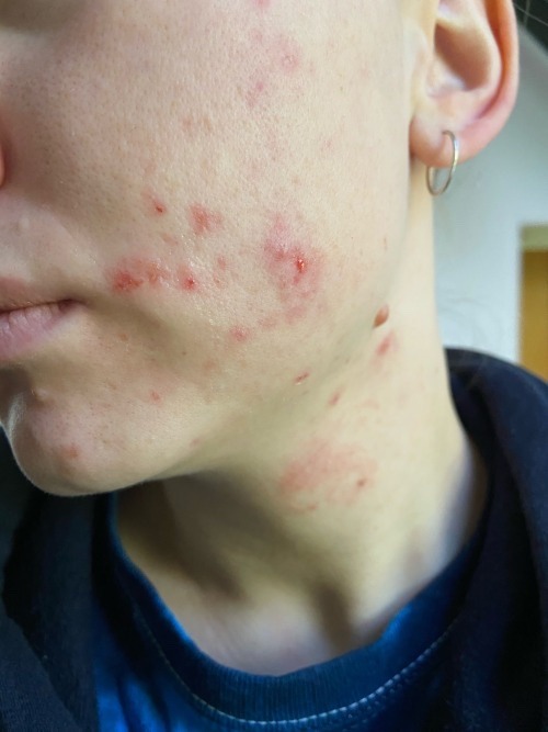 tretinoin burn scars tretinoin burn scars