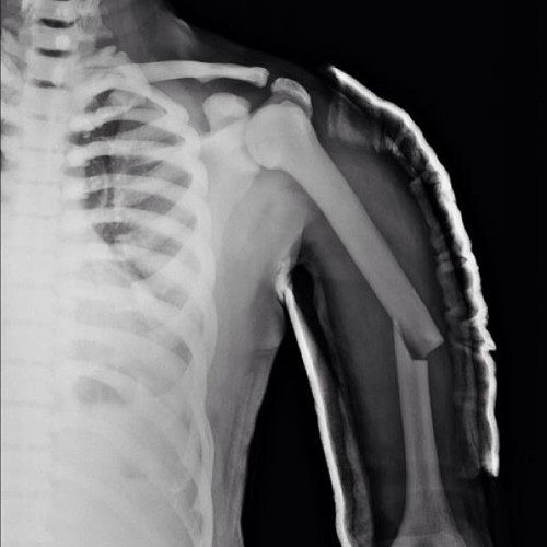 Radiopaedia Pathological Humerus Fracture In A Radiodiagnóstico Radiology