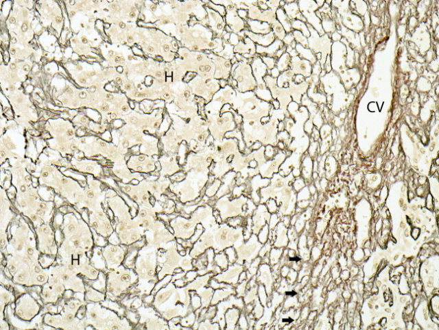 Medical Laboratory — Liver Disease Histology