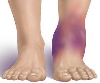 <p>What Is A Sprain?</p><p>A ligament is a thick band of fibrous material that connects bone to bone at a joint. A sprain occurs when the ligament tissue becomes stretched or torn.</p><p>Sprains can occur at any joint, the most common involve the ankle, wrist, and knee. Wrist sprains are often the result of a fall on an outstretched arm, where ankle and knee sprains occur where a twisting or sliding movement of body opposes the lower leg or foot. A “pop” or tissue tear may be experienced by the injured, depending on the severity of the sprain. Common symptoms of sprains include swelling, discoloration of the skin, pain, and a loss of functional ability at the joint. </p><p>The severity of a sprain is further classified into 3 grades (or degrees). </p><p>· A Grade 1, or mild sprain is a result of overstretching or a slight tearing of the ligament where no joint instability is present. Minimal pain and swelling are apparent with no significant loss of function at the joint. The joint should allow weight bearing with minimal limitations.<br/></p><p>· A Grade 2, or moderate sprain is a result of a partial ligament tear. Skin discoloration, pain and swelling are present at the site and there is a notable loss of function at the joint. Limited weight bearing is tolerated. An x-ray or MRI may be required to determine the severity of the injury.<br/></p><p>· A Grade 3, or severe sprain is a complete tear or disruption of the ligament. Bruising, swelling, and pain are severe and the patient cannot tolerate weight bearing through the joint. An x-ray is likely required to determine whether or not a bone has broken. Surgery is possibly required and immobilization of the injured joint is necessary for healing. </p>