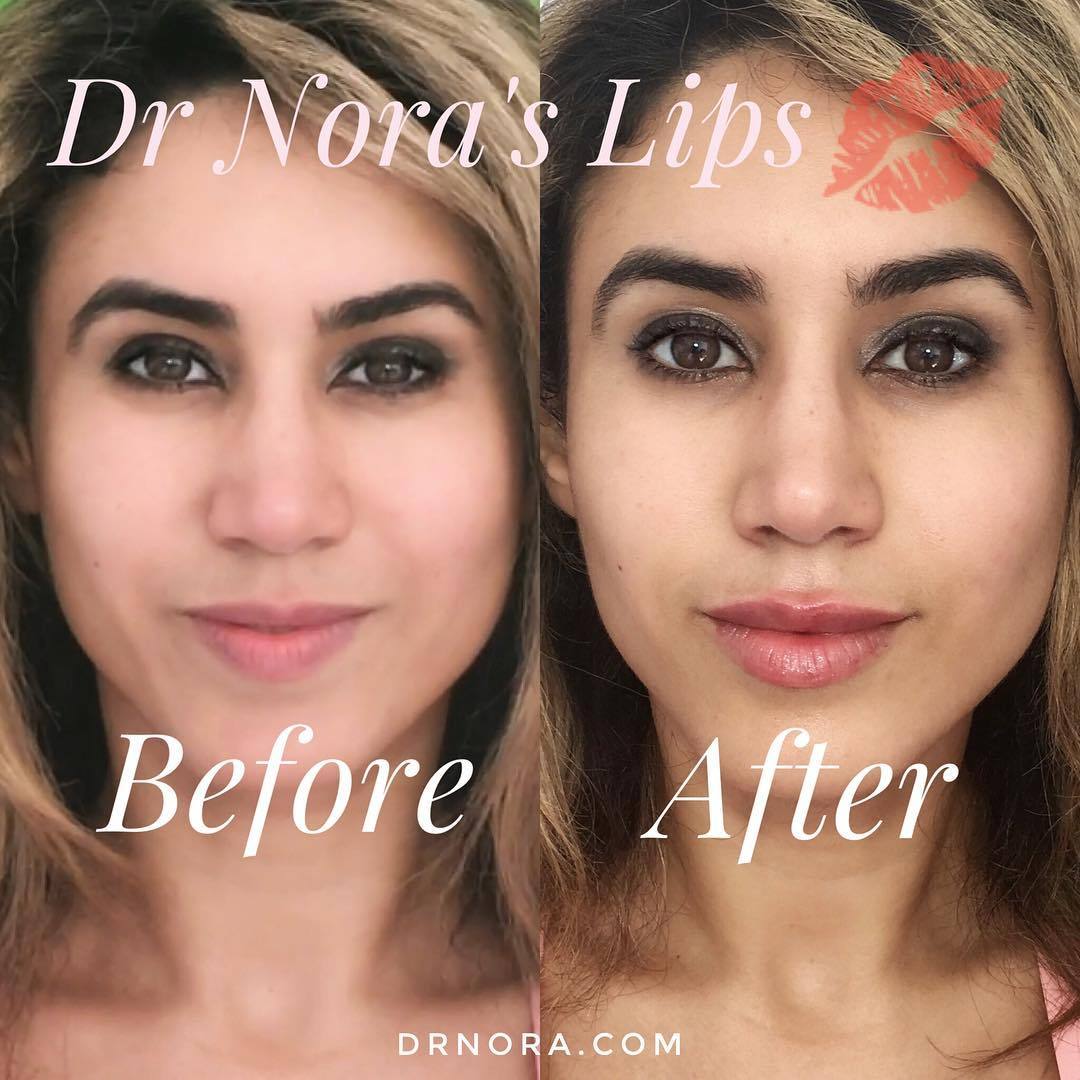 A little can go a long way! 💉I’ve used 0.4mls of lip filler on myself to give a plumper and fuller look. My Cupid’s bow is more defined and my lips look gorgeous! 💋
It just goes to show that you don’t need a lot to make a dramatic difference to the...