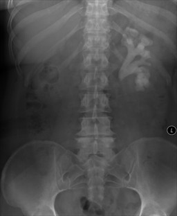 staghorn calculus | Tumblr