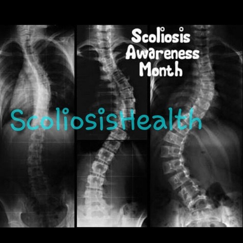 Scoliosis Health