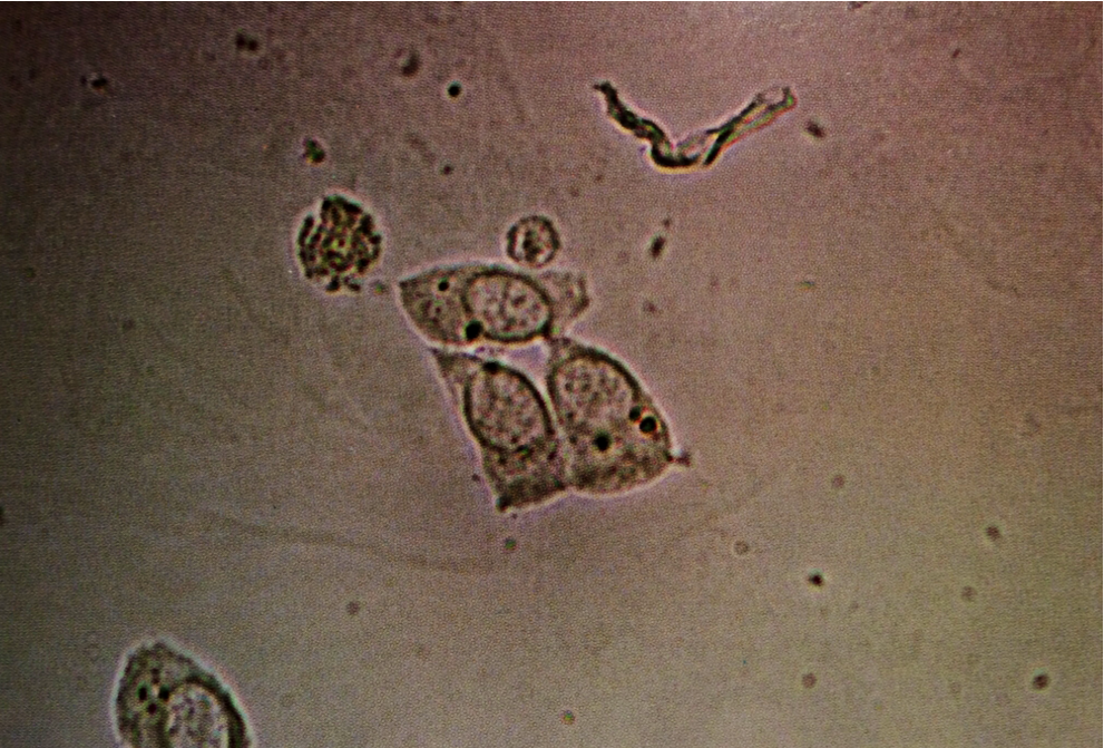 Renal Cells In Urine Sediment 1495