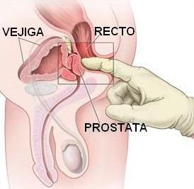 cómo perder prostatitis cómo perder prostatitis