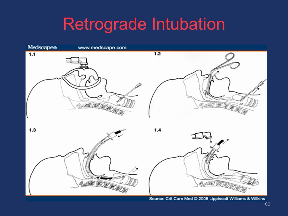 Blind Nasotracheal Intubation