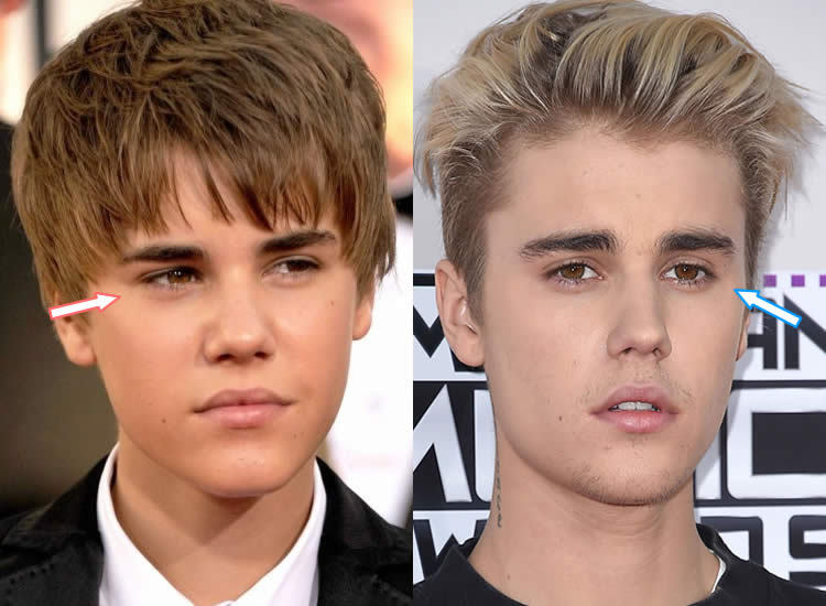 Before And After Justin Bieber Plastic Surgery