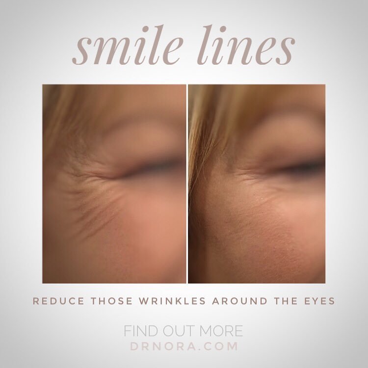 Love to smile but don’t love the lines? ๐Anti-wrinkle treatment helps to reduce the appearance of soft and deep lines when placed carefully around the eyes. This patient had a fantastic result from her treatment ๐๐ Anti-wrinkle therapy is quick and...