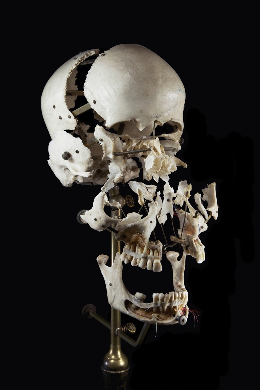 Jackdclxvi  Exploded And Dissected Skulls Beauchene Skull-3767