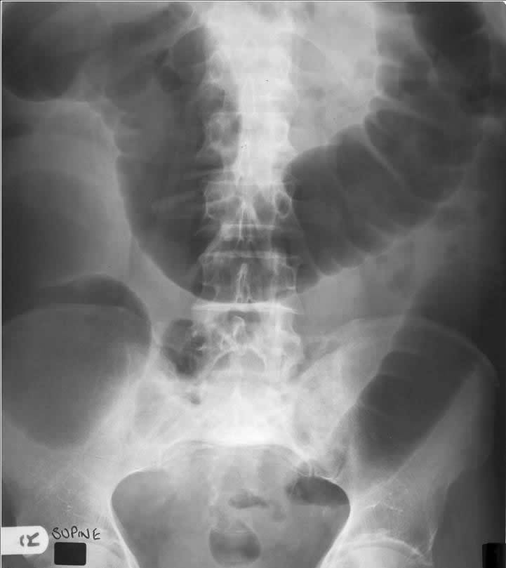 Large Bowel Diameter