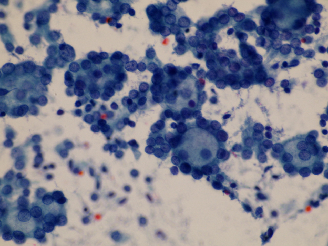 Pathology Cloud • Follicular Neoplasm, Thyroid lesion Hyper...