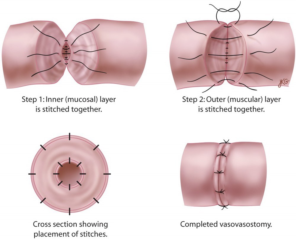 Malformed sperm after vasectomy reversal Malformed sperm after vasectomy reversal