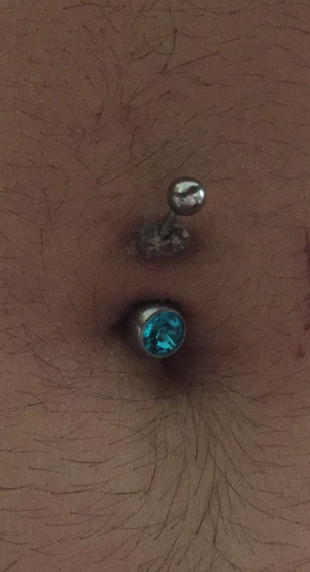 Belly piercing bump on dark skin 