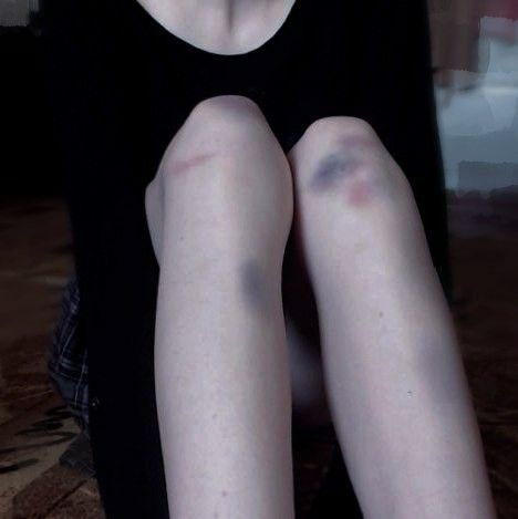 beforeimskinny:✨grunge bruised thinspo - before i’m skinny✨