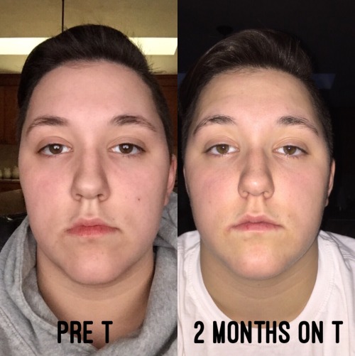 2 months on T face comparison! I can see a difference but I...