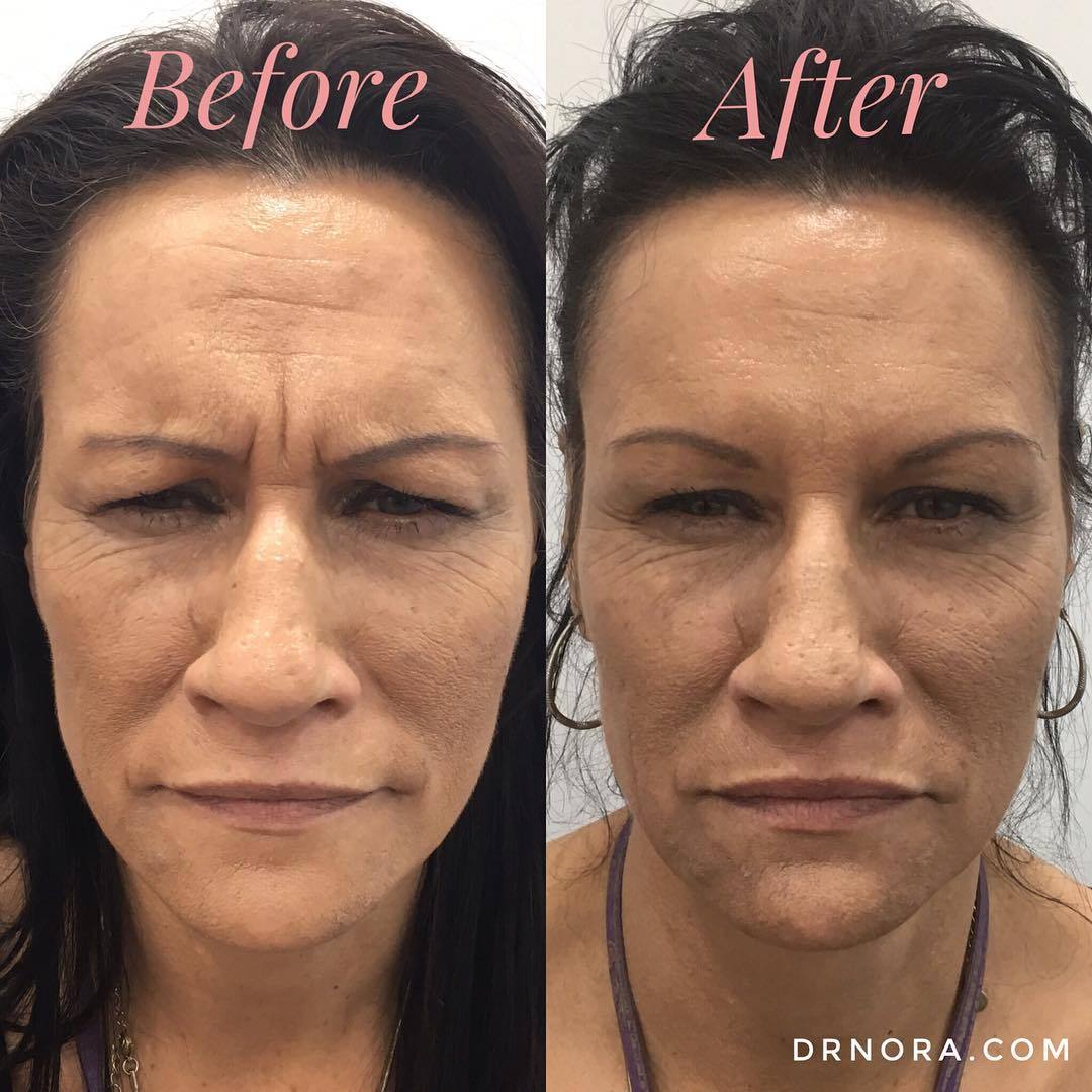 Can you spot the difference❓Anti-wrinkle treatment is a quick and easy way to reduce frown lines giving a fresh and youthful appearance. This lovely lady had a fantastic outcome and was very pleased with her results!
Results show at 2 weeks and...