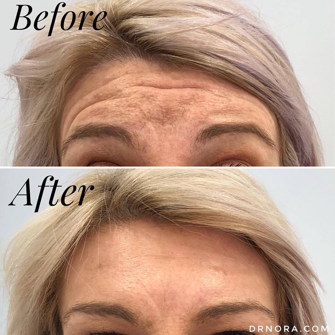 What a great start to the week! ๐This lovely patient had a fantastic result from anti-wrinkle treatment of her forehead. The deep lines have dramatically reduced!
Anti-wrinkle treatment is a quick and easy way to reduce facial lines giving a fresh...