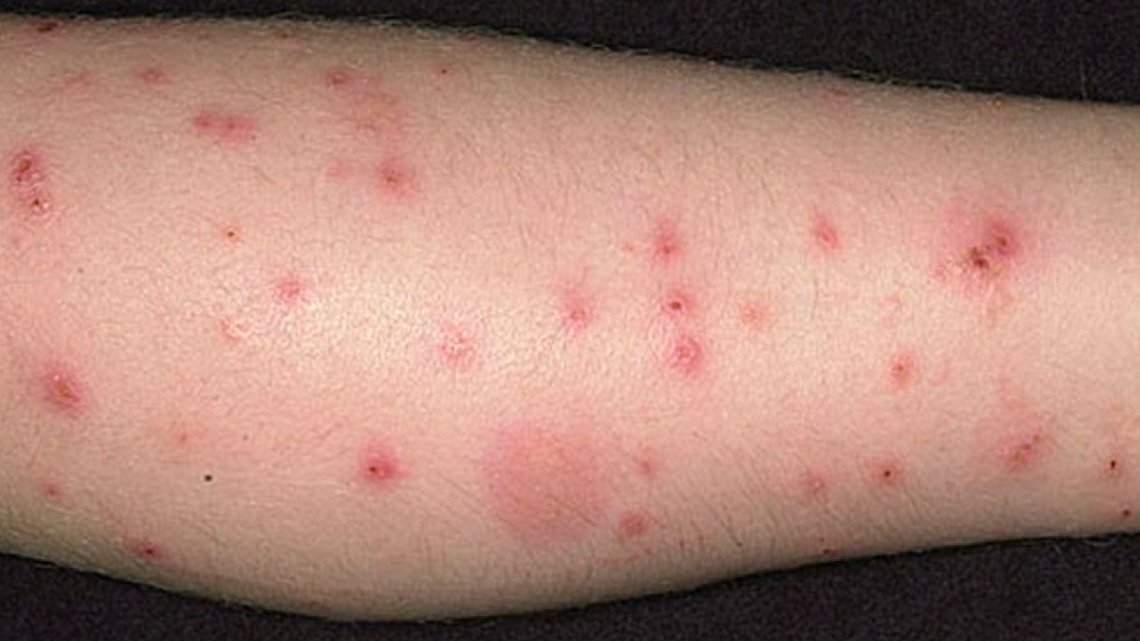 Humanos pulga en complicaciones de picadura