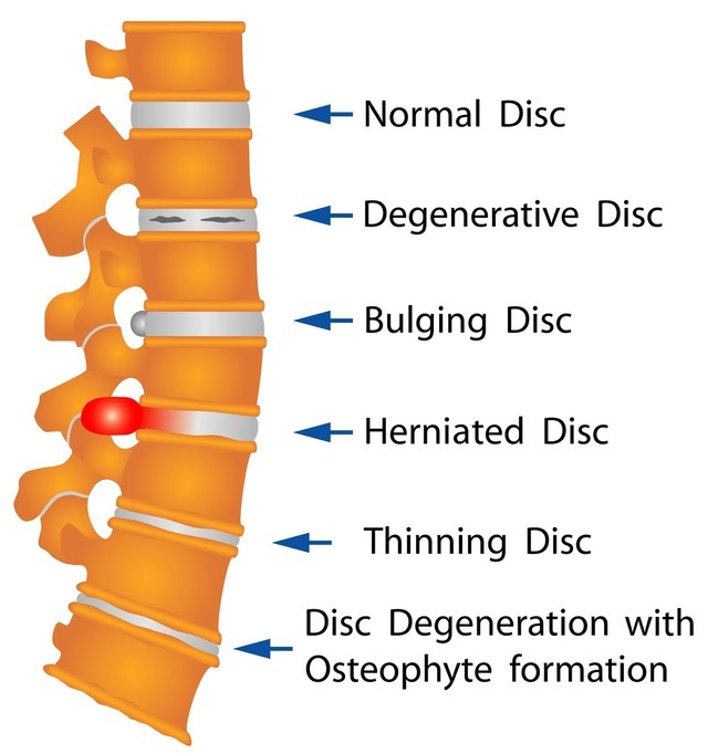 how many discs in spine